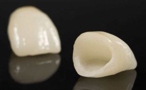 Pourquoi rêver de couronne dentaire ?