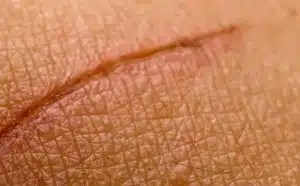 Pourquoi rêver de blessure cicatrisée ?