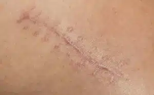 Pourquoi rêver de cicatrice ?