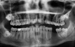 Rêver de dents manquantes dans la bouche : quelles interprétations et significations ?