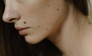 Pourquoi rêver d'un grain de beauté sur le visage ?