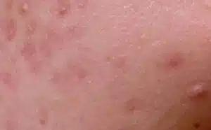 Pourquoi rêver d'être couvert de boutons ?