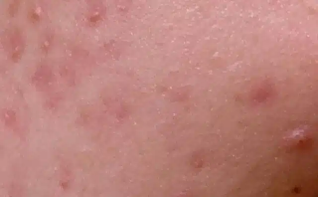 Pourquoi rêver d'être couvert de boutons ?